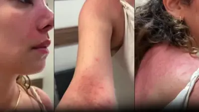 Bali Tatilinde Şok Edici Gelişme: Türk Turist ATV Turu Sonrası Ağır Alerjik Reaksiyon Geçirdi