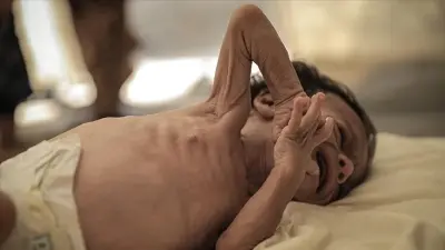 Bangladeş'te Kızamık Kayıpları Artıyor: 409 Çocuğun Hayatını Kaybettiği Bildirildi